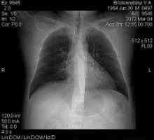 Fibroză pulmonară