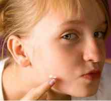 De ce am și cum să eliminați acnee pe obraji