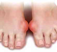 Gout: simptome și tratament