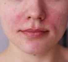 Înroșire și inflamație a pielii, tratamentul