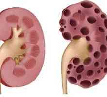 Boli de rinichi polichistic - cauze, simptome și tratament