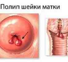 Polip in uter in timpul sarcinii, cauze, tratament