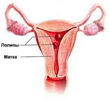Polipii in uter: simptome și tratament