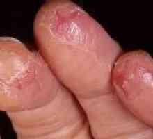 Cauzele și tratamentul fisuri pe mâinile și degetele