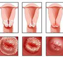 Cauterizare de eroziune de col uterin