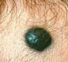 Caracteristicile și metode de tratare a ganglionilor limfatici de melanom