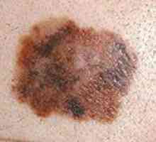 Prognozele de speranță de viață de melanom pielii