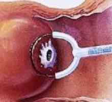 Tratamentul Radiowave de eroziune de col uterin