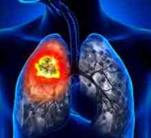 Lung Cancer: Simptome si semne