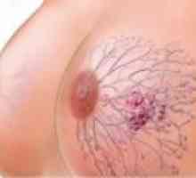 Breast Cancer: Cauze, simptome, tratament