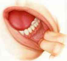 Cancerul oral