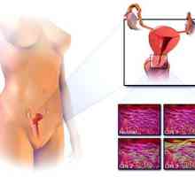 Cancerul de col uterin: Semne si simptome