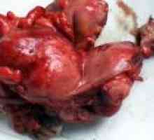 Cancerul de col uterin - previziuni tratamente