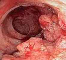 Cancerul de colon - Tratamentul si prognosticul
