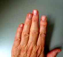 Artrita reumatoida a degetelor, primele simptome