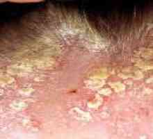 Dermatita seboreica pe cap, tratament