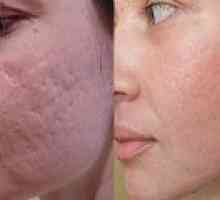 Cicatrici acnee - cum să eliminați?