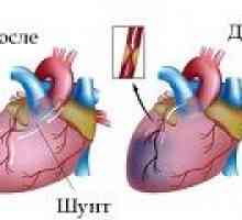 Navele de chirurgie de by-pass cardiac (bypass aorto-coronarian)