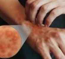 Simptomele și tratamentul dermatitei atopice