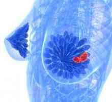 Simptomele și tratamentul chisturilor mamare