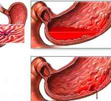 Simptome și tratament de gastroduodenită