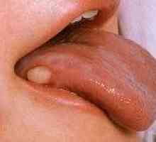 Simptomele de cancer al limbii