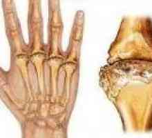 Simptomele de artrita reumatoida