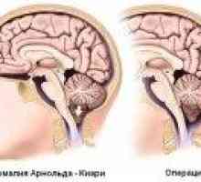 Sindromul Arnold Chiari: Cauze, simptome, tratament