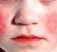 Sindromul Kawasaki la copii: Cauze, Diagnostic, Tratament
