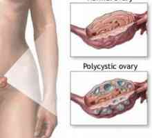 Sindromul ovarului polichistic