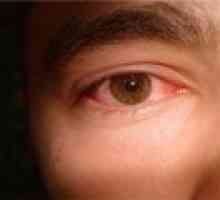 Sindromul de ochi uscat - cauze, simptome, tratament
