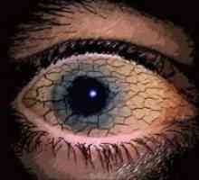 Sindromul de ochi uscat
