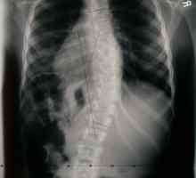 Scolioza a coloanei vertebrale la adulți: diagnosticarea, prevenirea, tratamentul