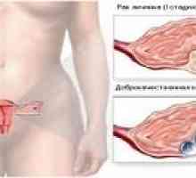 Stadiul de cancer ovarian la femei