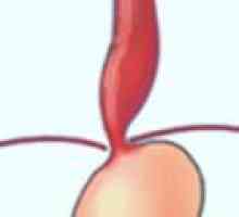 Stenoza (îngustarea) a esofagului - cauze, simptome, tratament