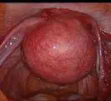 Submucoasă (submucoasă) fibrom uterin, simptome, tratament