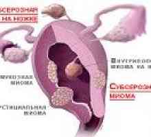 Fibrom uterin subseros - cauze, simptome, tratament
