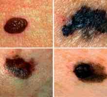 Tipuri de melanoamelor și clasificarea lor