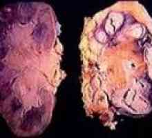 Tuberculoza a rinichilor: cauze, simptome, tratament