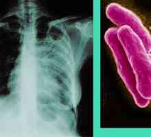 Tuberculoza - semne și simptome de