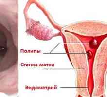 Eliminarea polipilor endometriali: modul în care tratăm