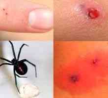 Mușcături Spider - simptome, tratament