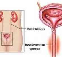 Uretrita la femei - cauze, simptome, tratament