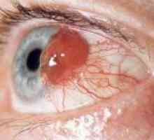 Melanom uveal, sau cancer al ochiului: cum să identifice și să trateze