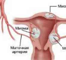 Fibrom uterin nodular - cauze, simptome, tratament