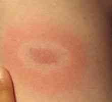 Eritemul nodos - cauze, simptome, diagnostic și tratament