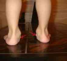 Picioare valgus plat la copii: cauze si tratament