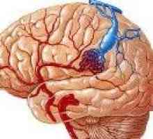 Angiom Venoase a creierului (cerebel, lobul frontal)