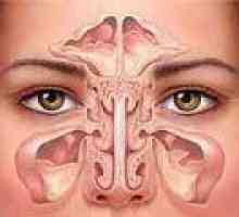 Sinuzita maxilară: acută și cronică