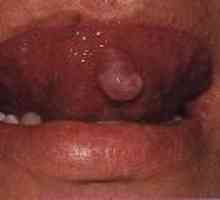 Tipuri de tumori benigne orale: cauze, simptome, tratament